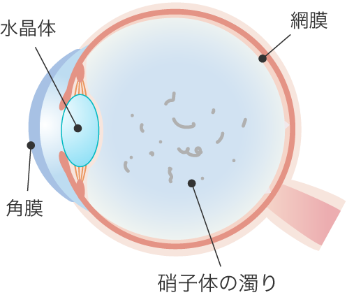 飛蚊症の眼