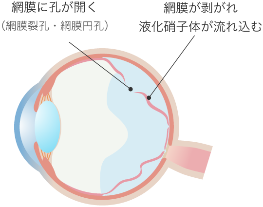 網膜剥離の眼
